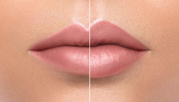 labios antes y despues de una sesion de hyaluronic pen labios