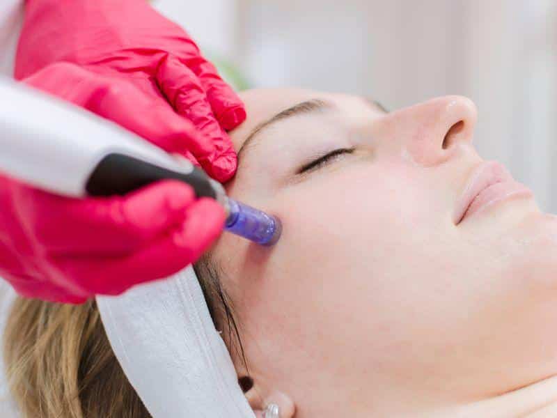 mujer experimentando el tratamiento facial dermapen